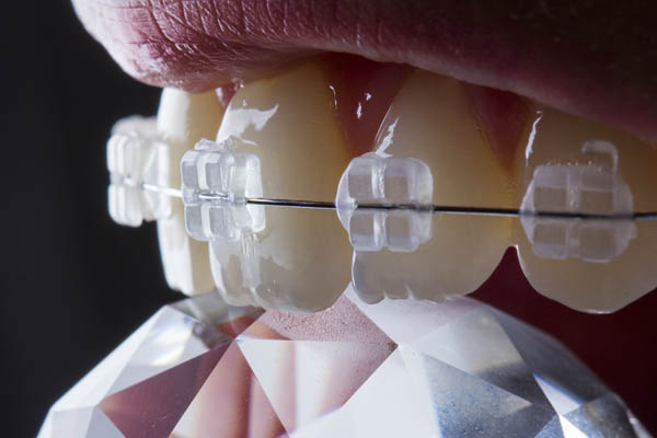 Dental Braces NYC (Ceramic, Clear)