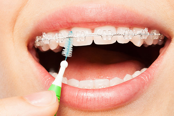 Why You Should Consider Clear Braces - New York Dental Office New York New  York